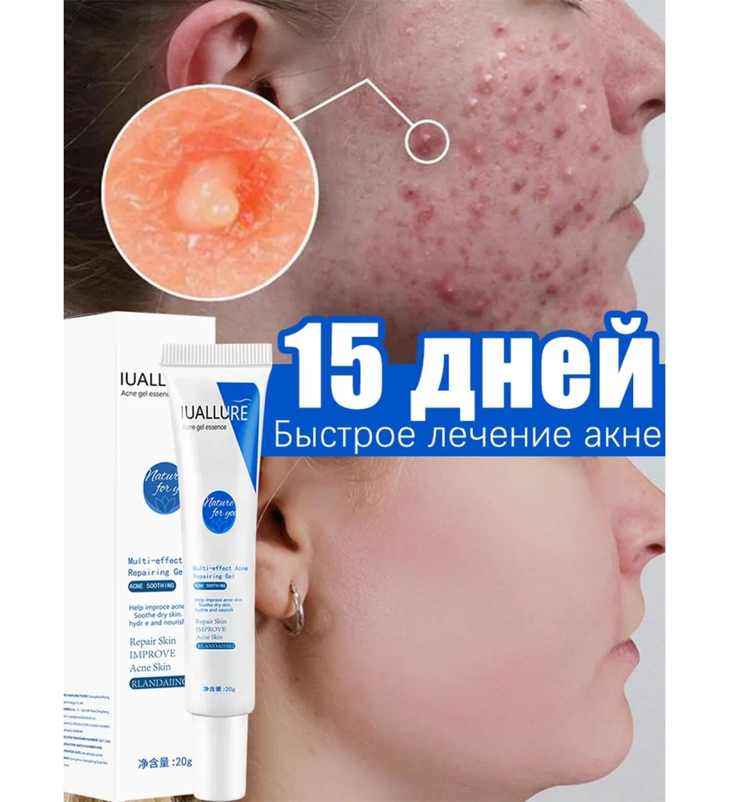 Acne acne gel and traces after them - Buy Online on GoSupps.com