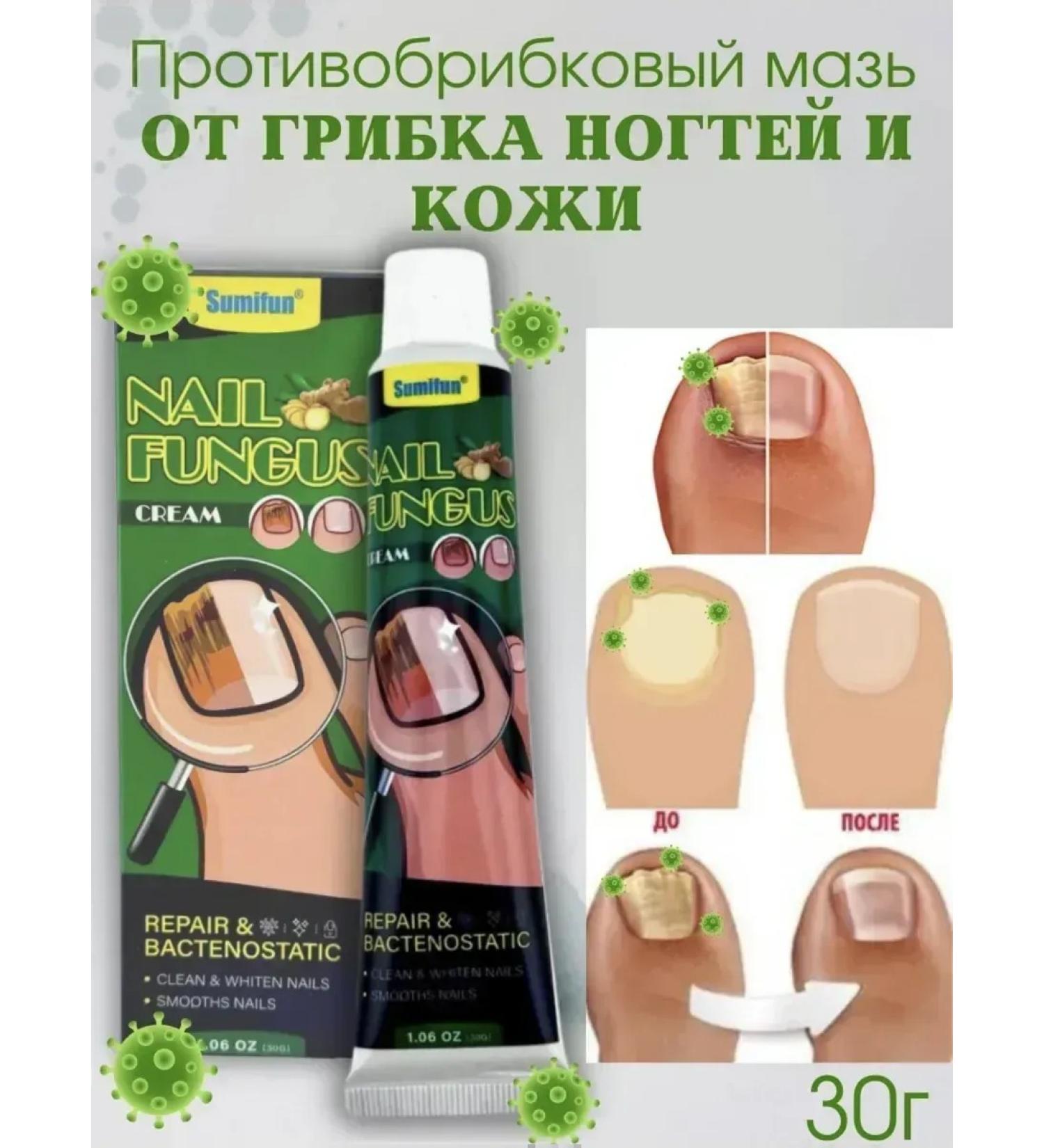 Cream-mask from nail fungus