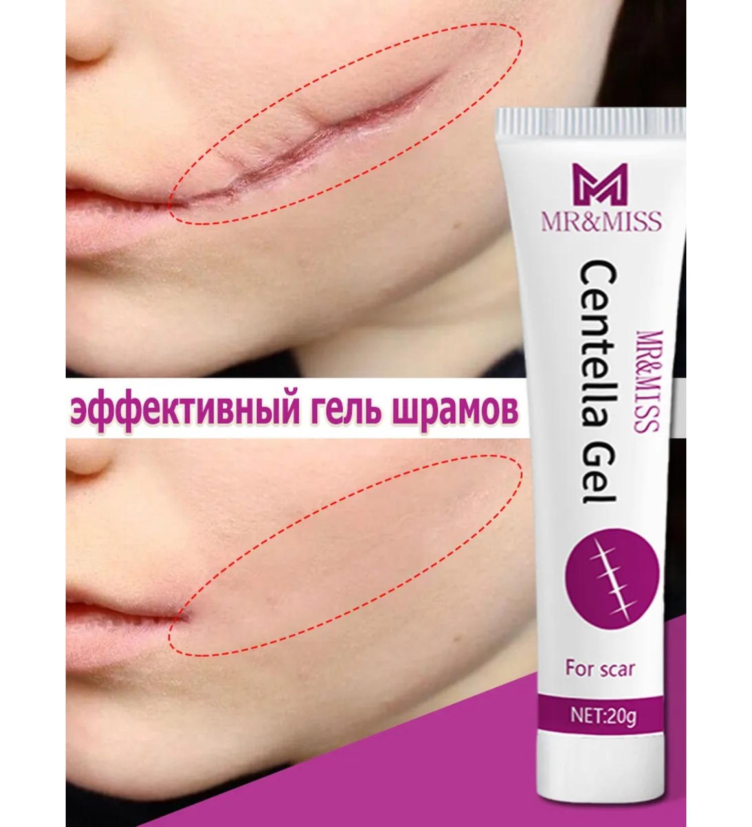 Cream for skin against stretch marks and scars makes it smooth - Buy Online on GoSupps.com