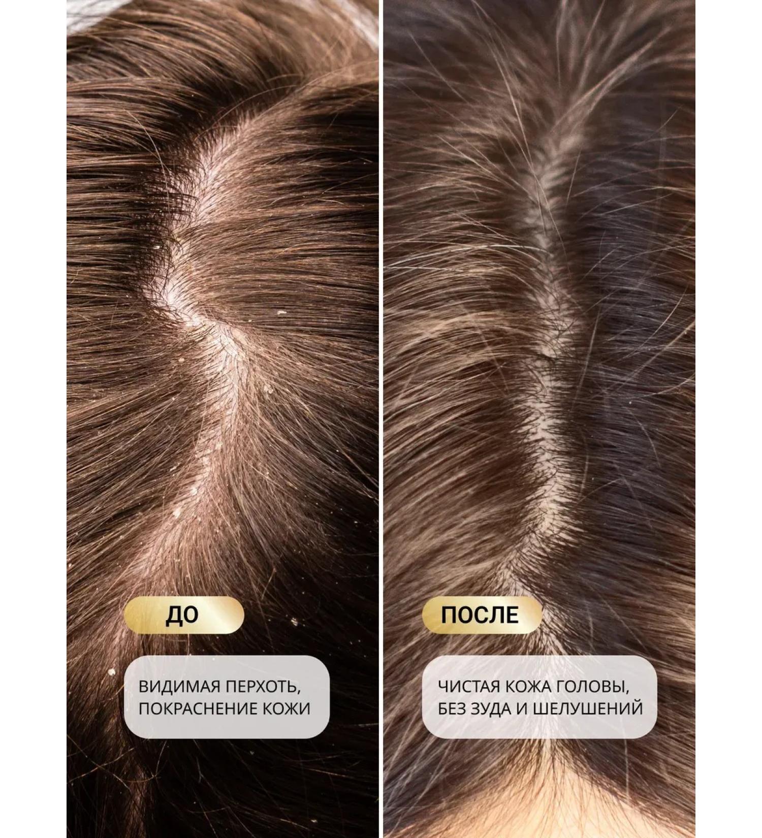 ShampoosBench Hard hair shampoo from dandruff
