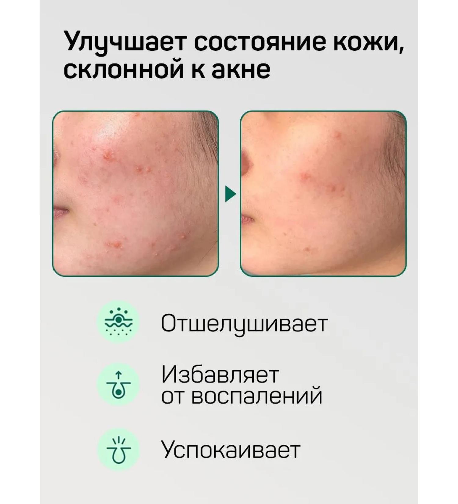 GelsOnline Foam for washing the face Korean from acne - Buy Online on GoSupps.com