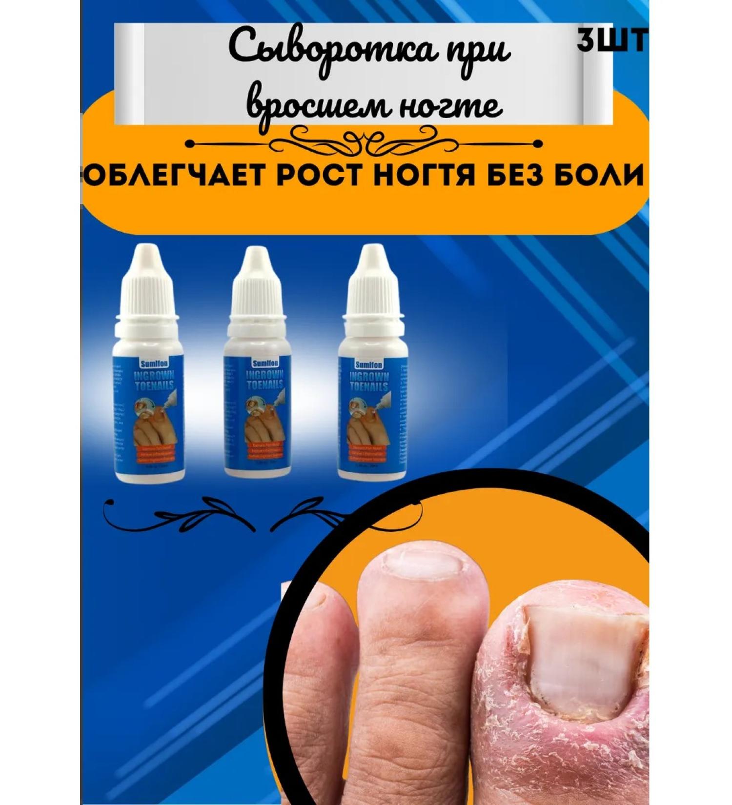 ARUUM Caring for an ingrown fingernail without pain