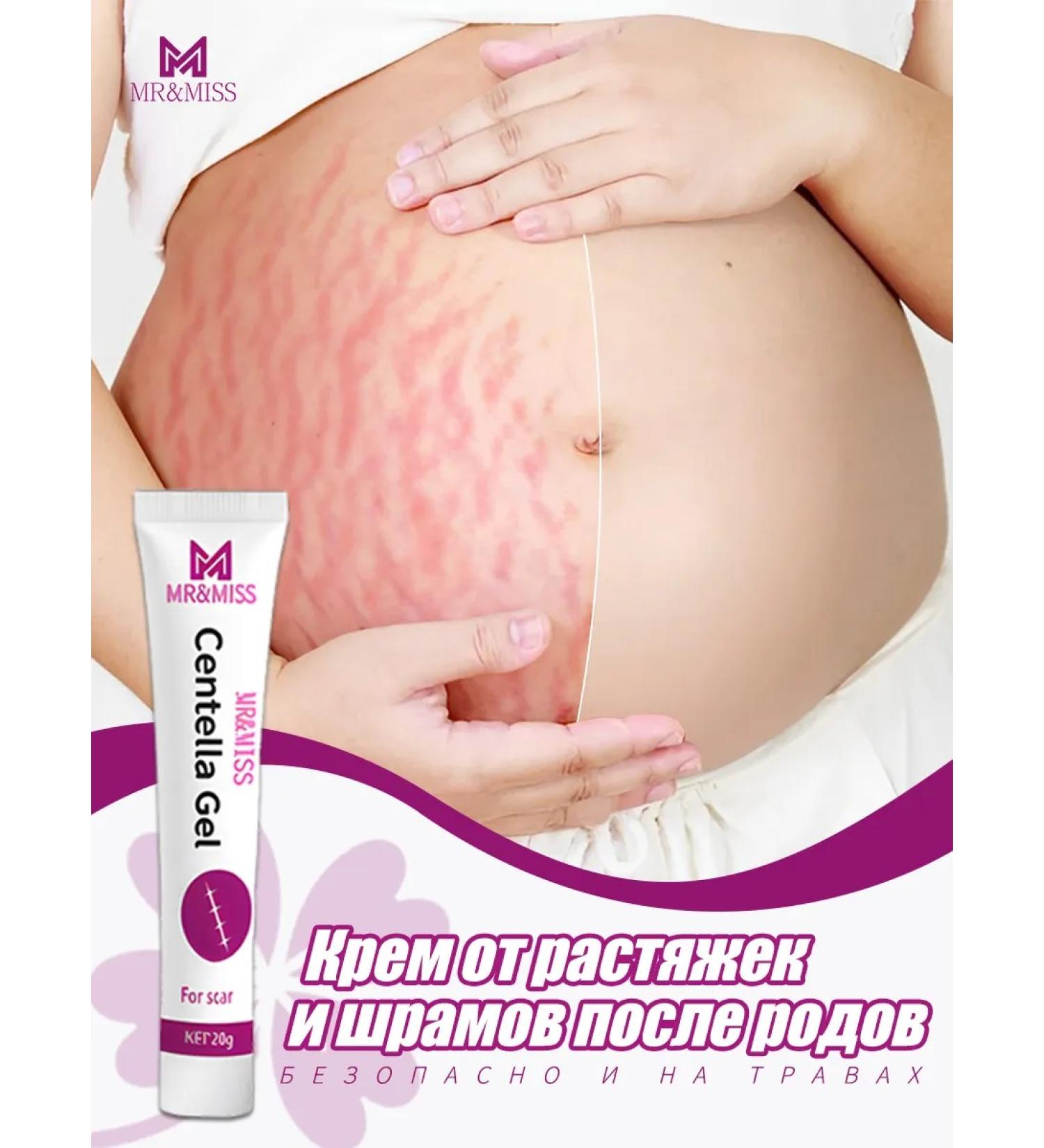 Cream from stretch marks and scars after giving birth 20 g - Buy Online on GoSupps.com