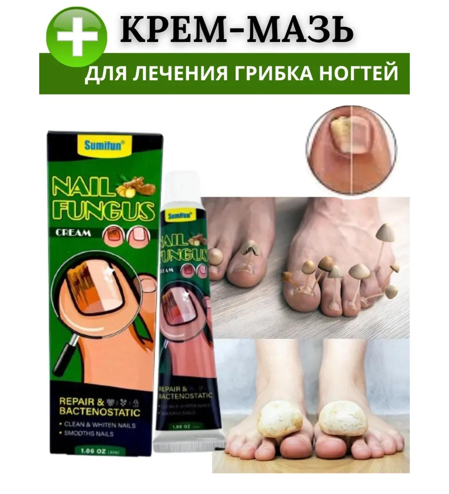 AWESOME PRICES Cream from nail fungus smell and cracks against onychomycosis - Buy Online on GoSupps.com