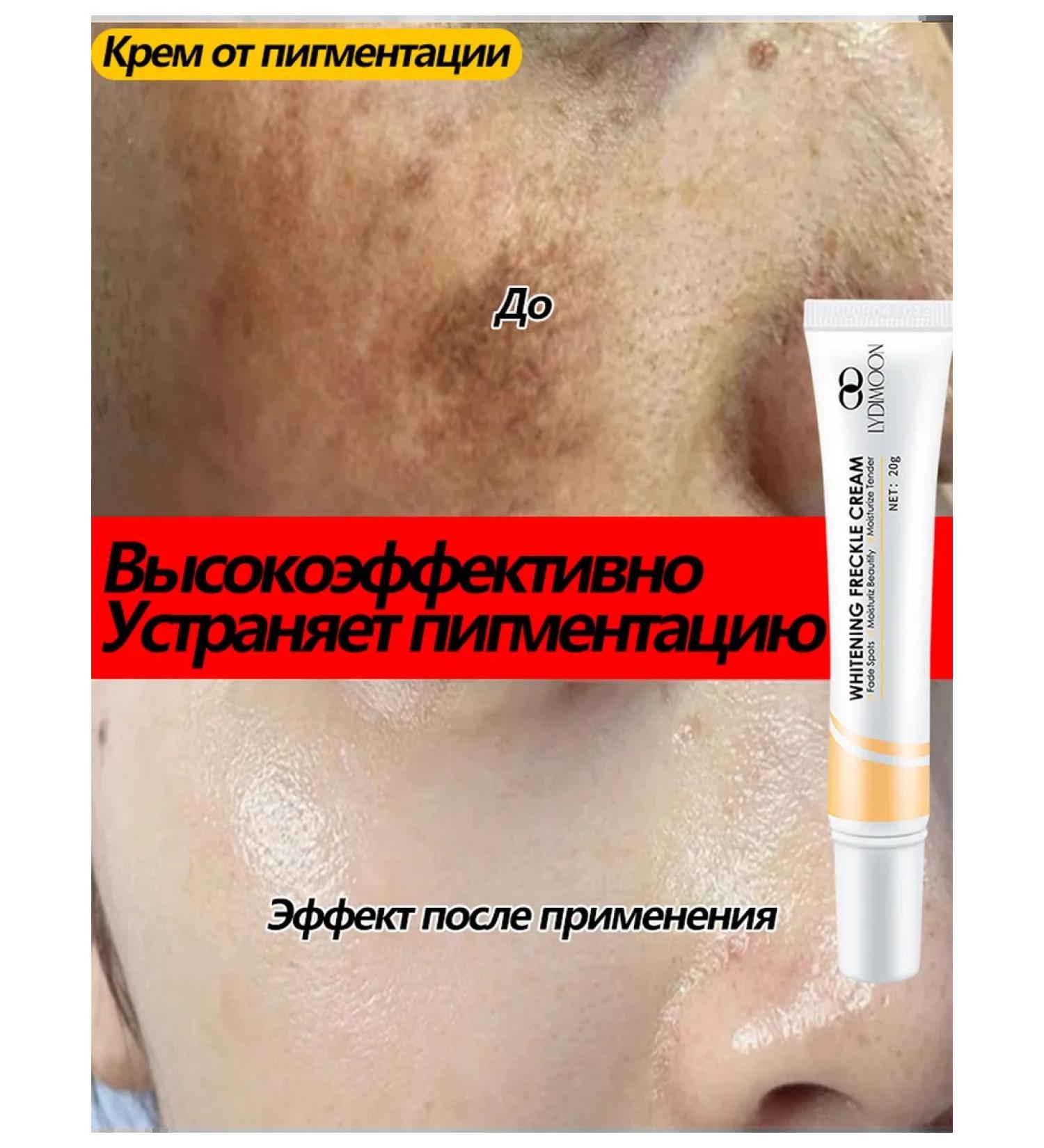 Pigmentation cream 20g effectively removes freckles with melasm