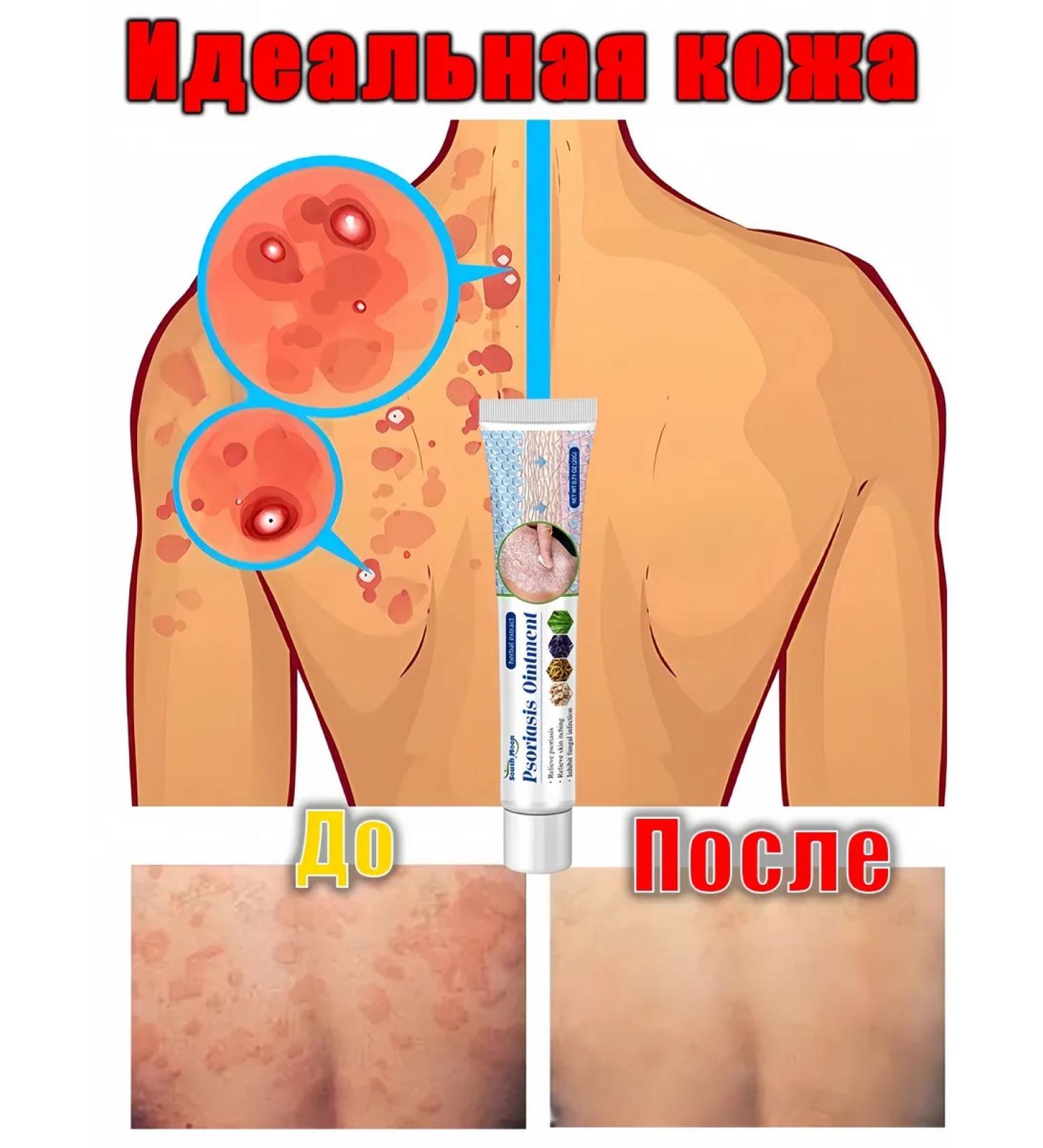 DRSKINVITA Skin care cream from psoriasis 20 g - Buy Online on GoSupps.com