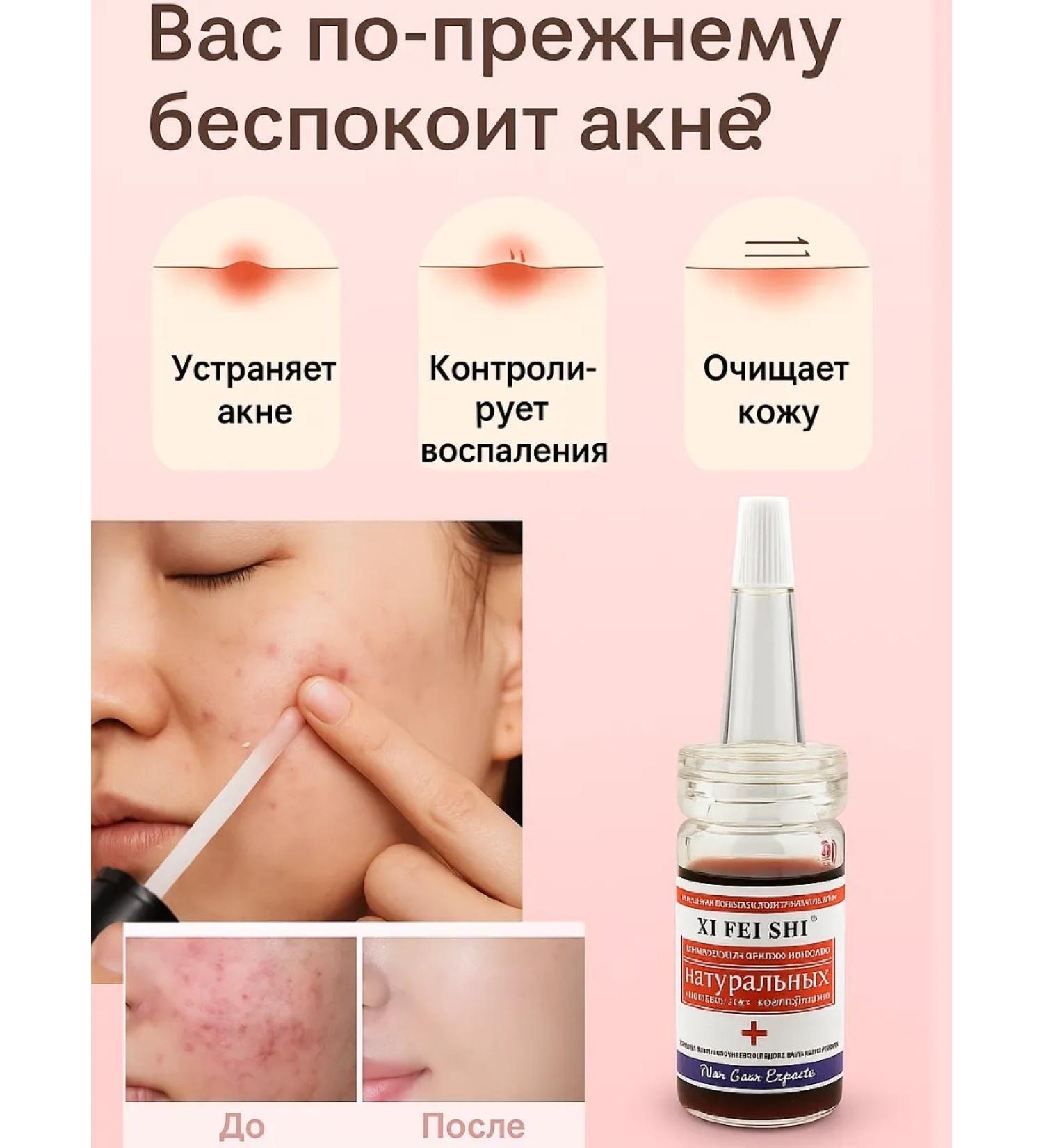 TA1612 Acne and pimple remedy - Buy Online on GoSupps.com