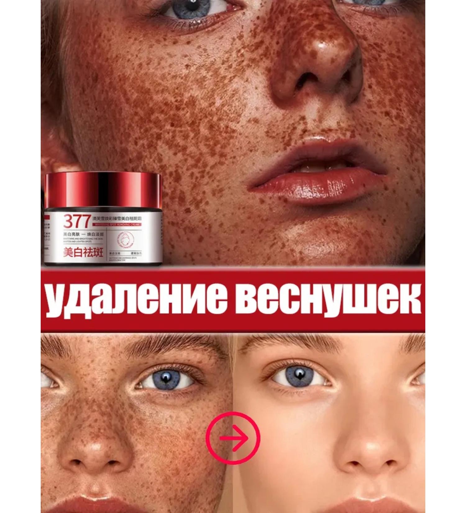 Cream against freckles Removing Sun Sun spots Removing - Buy Online on GoSupps.com