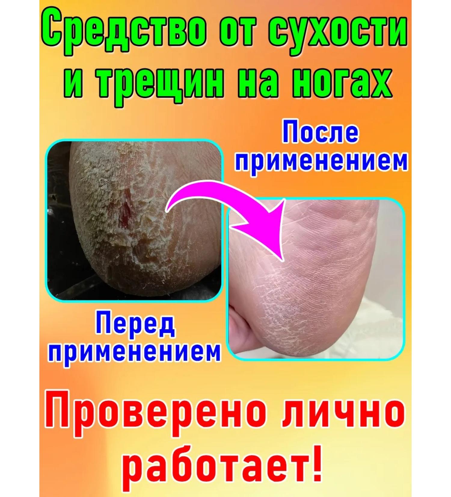 Moisturizing nourishing cream for legs and hands from cracks - Buy Online on GoSupps.com