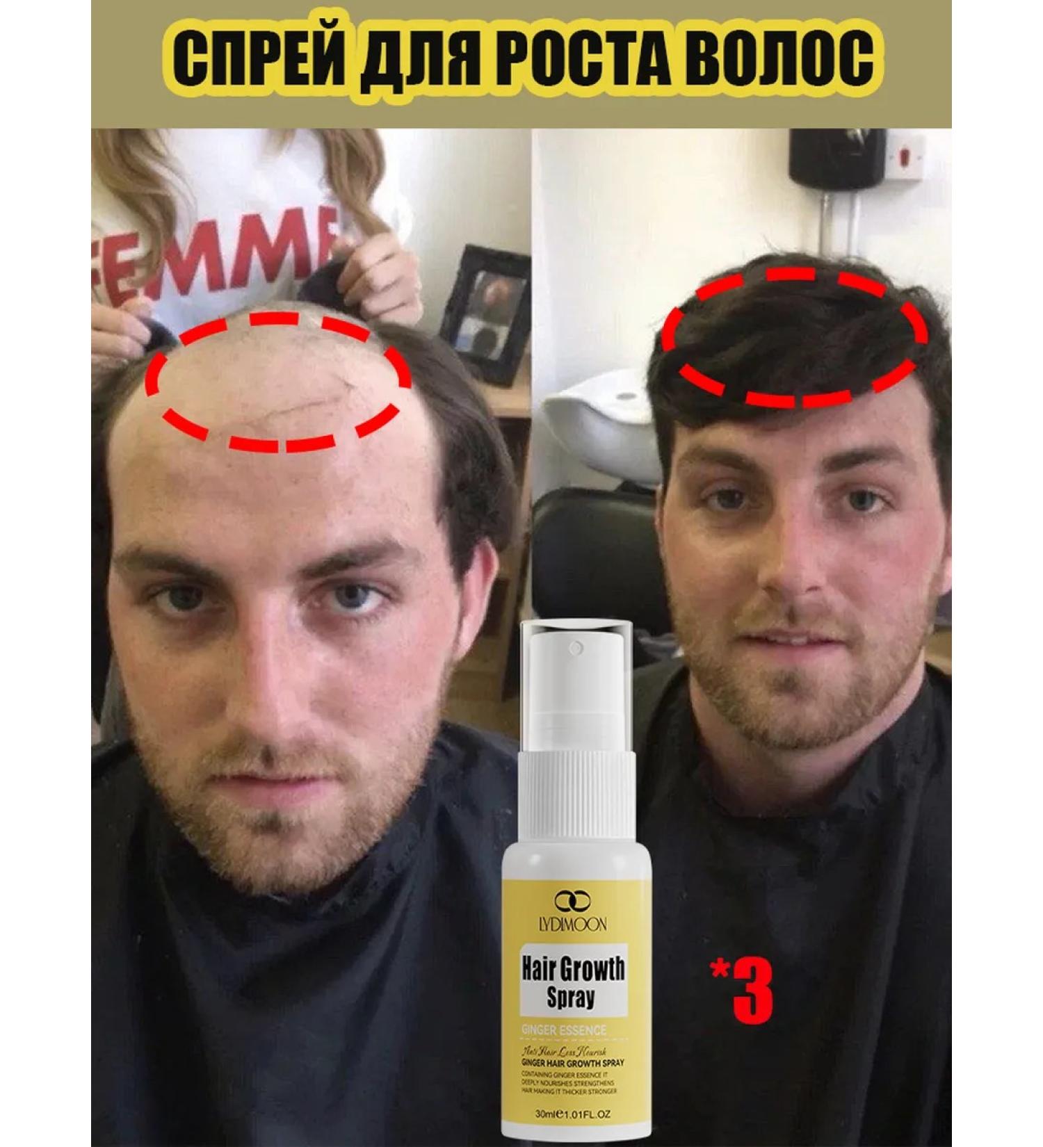 LYDIMOON Hair growth spray 30ml*3 - Buy Online on GoSupps.com