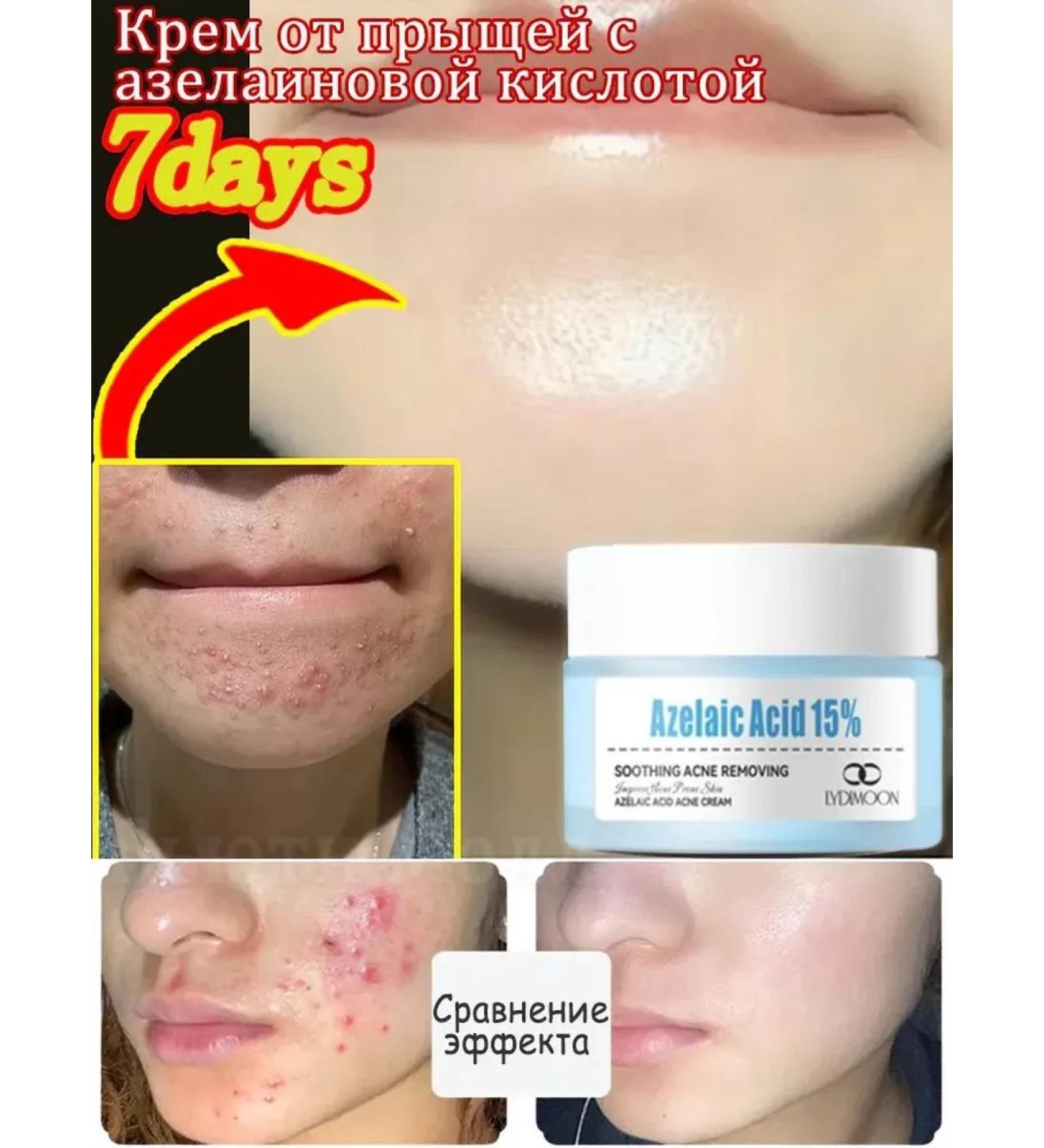 LYDIMOON Acne cream with azelainic acid 30 g - Buy Online on GoSupps.com