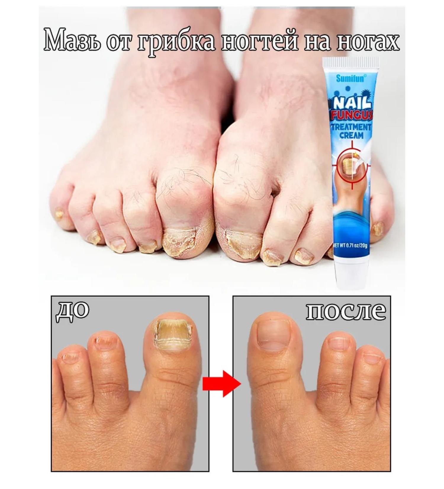 Antibacterial nail cream 20 ml - Buy Online on GoSupps.com