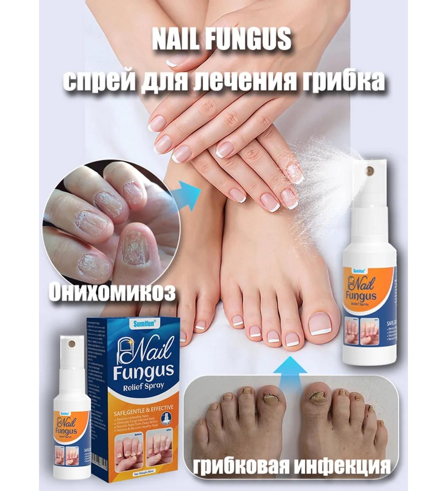 Nail Fungus spray from nail fungus on the legs of onychomycosis 30 ml - Buy Online on GoSupps.com