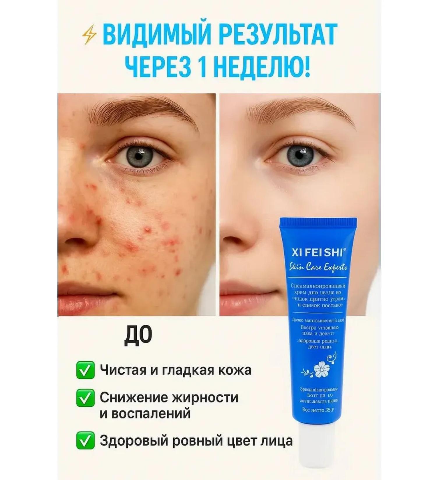 TAR Pimpling cream for problem skin - Buy Online on GoSupps.com
