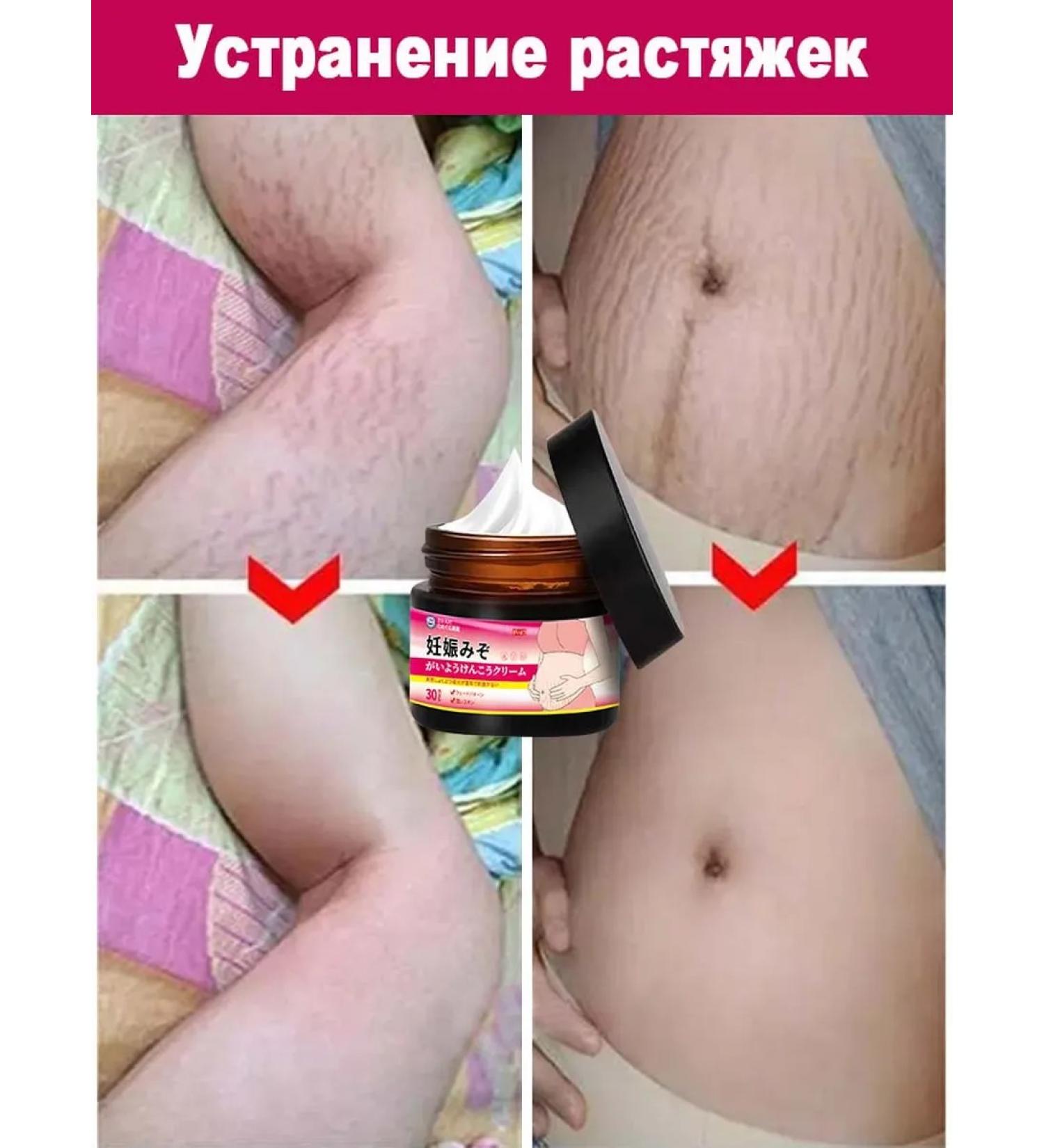 Stretching cream for pregnant women Removing stretch marks