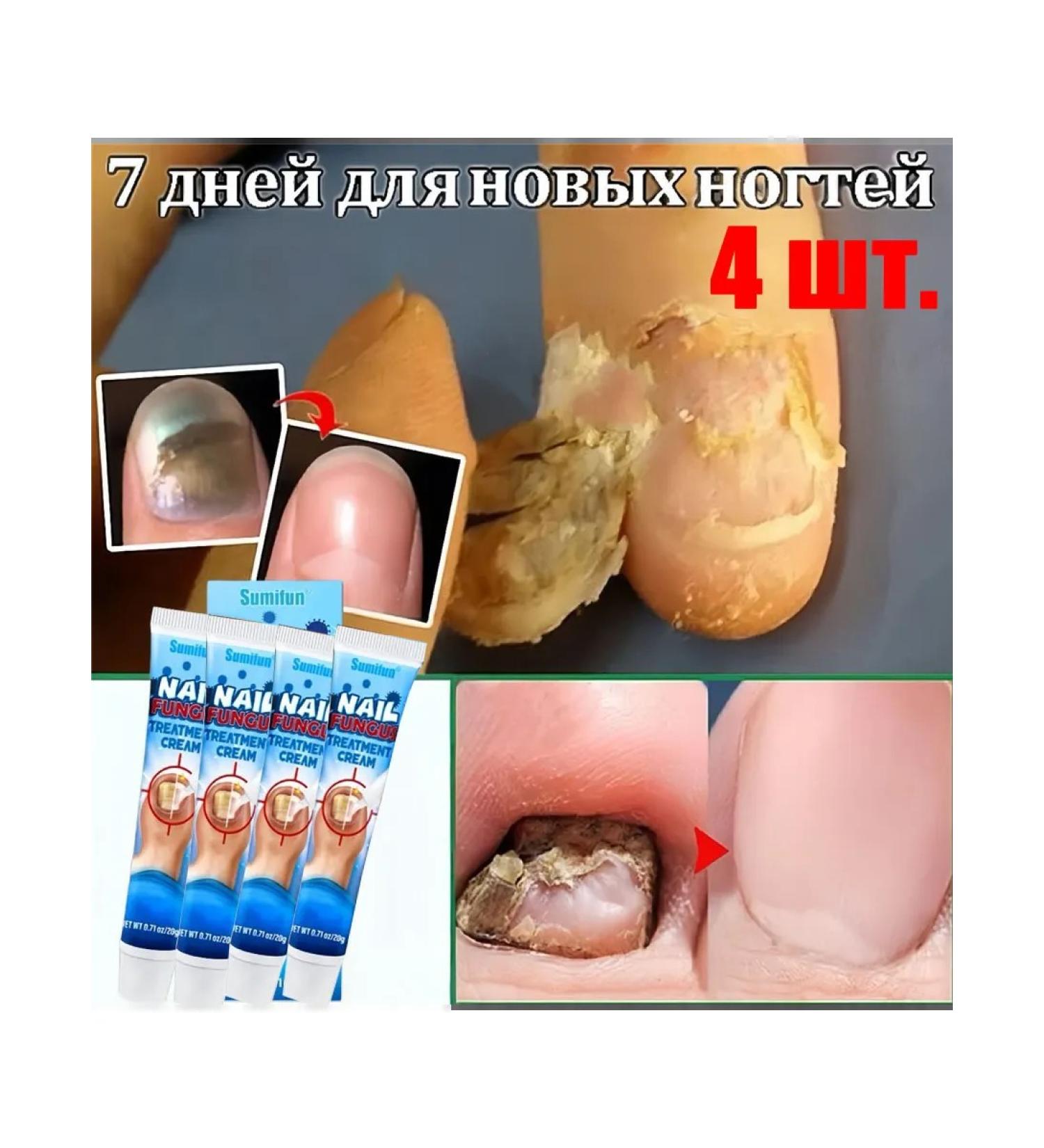 2*20 g of ointments from nail fungus to eliminate inflammation - Buy Online on GoSupps.com