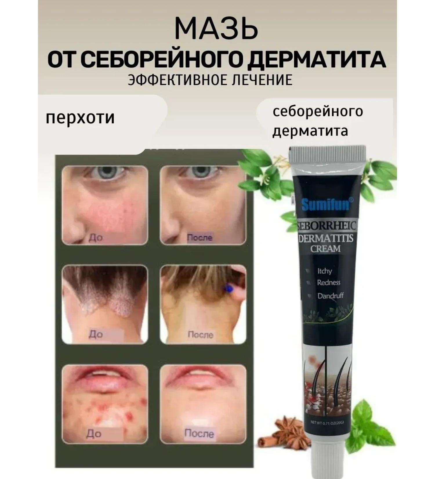 Life Antifungal cream from itching dandruff seborrheic dermatitis - Buy Online on GoSupps.com