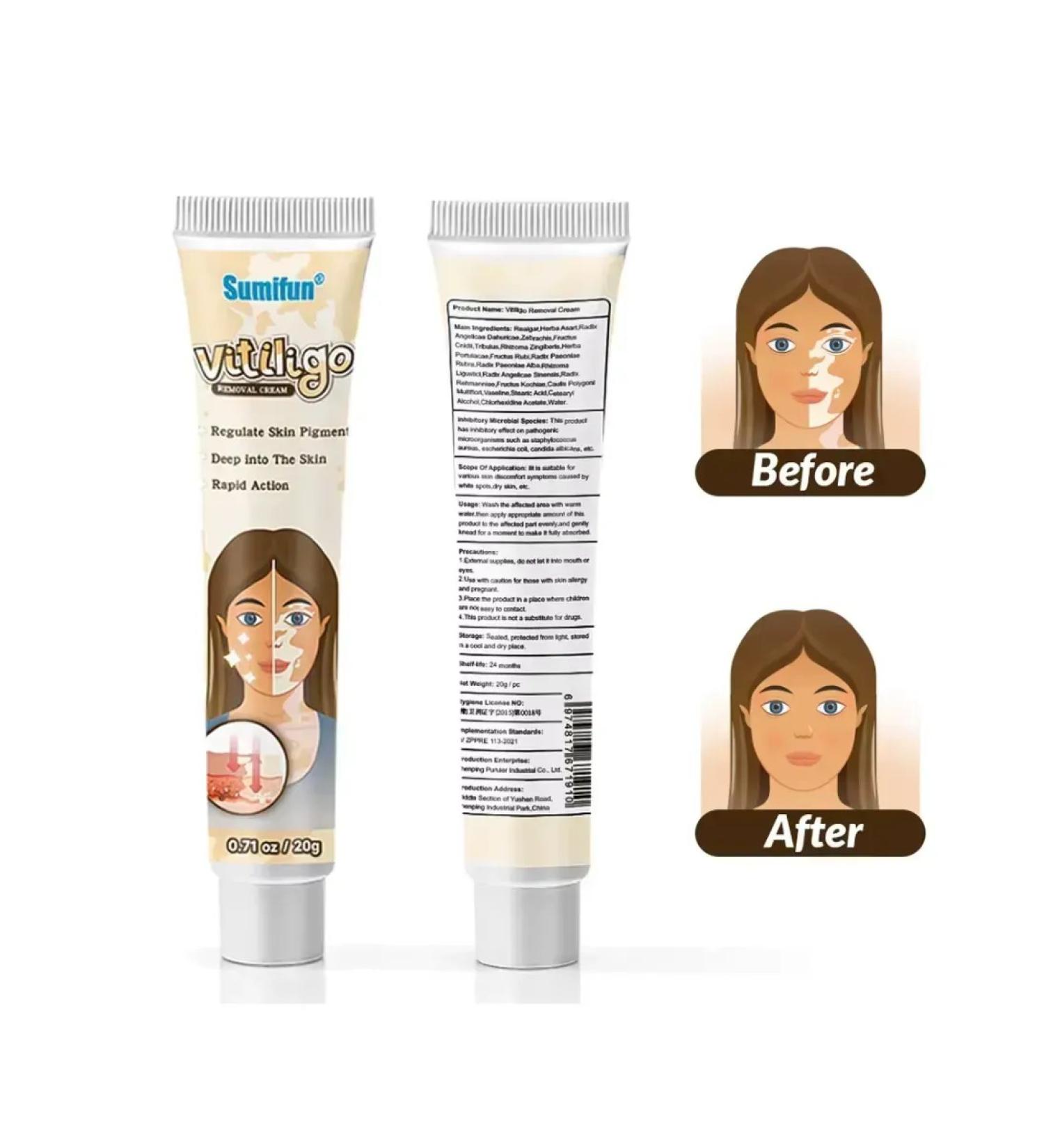 Spoty Brand Ointment from pigment spots from vitiligo cream - Buy Online on GoSupps.com