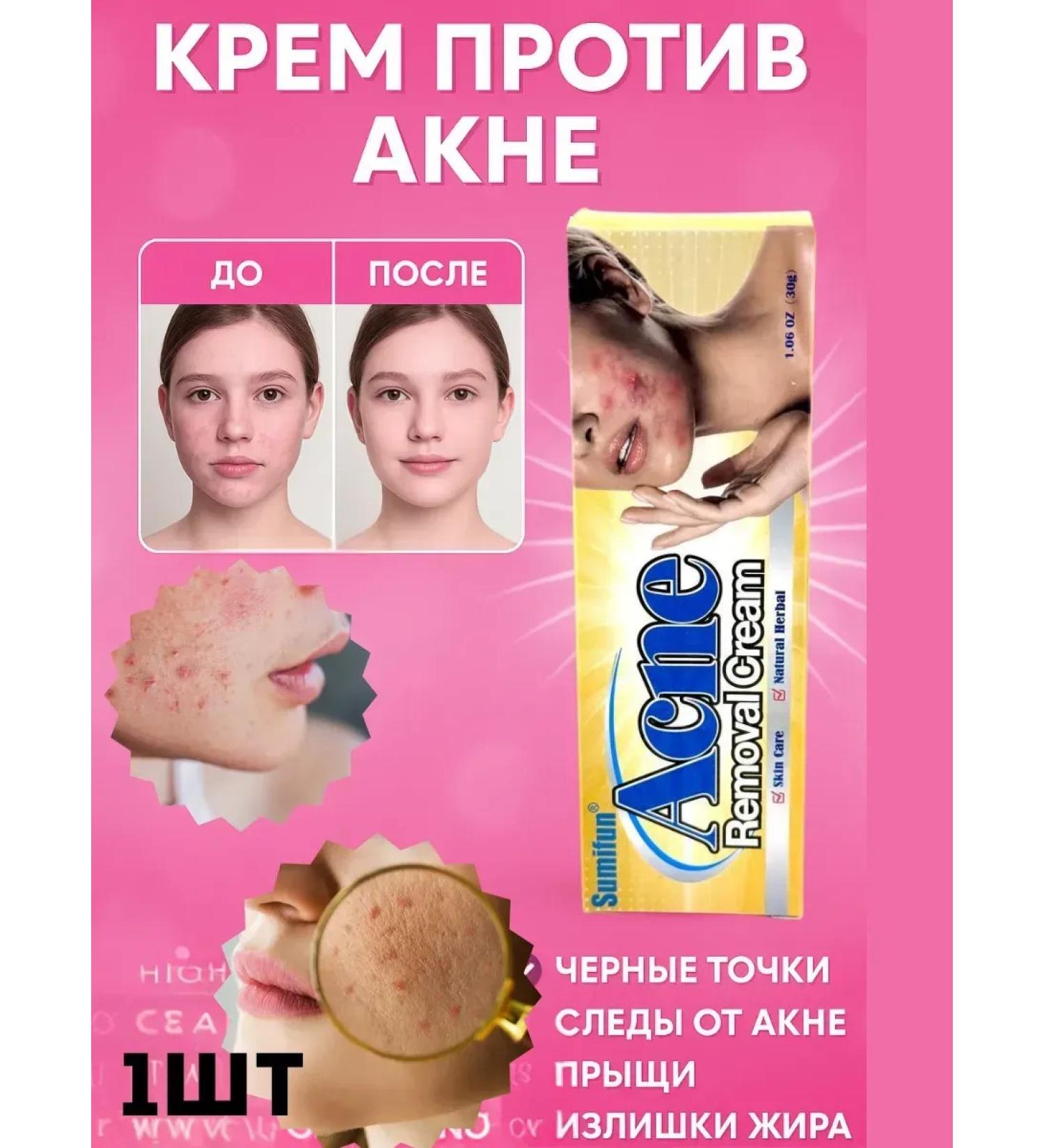 MadiMax Acne and acne cream - Buy Online on GoSupps.com