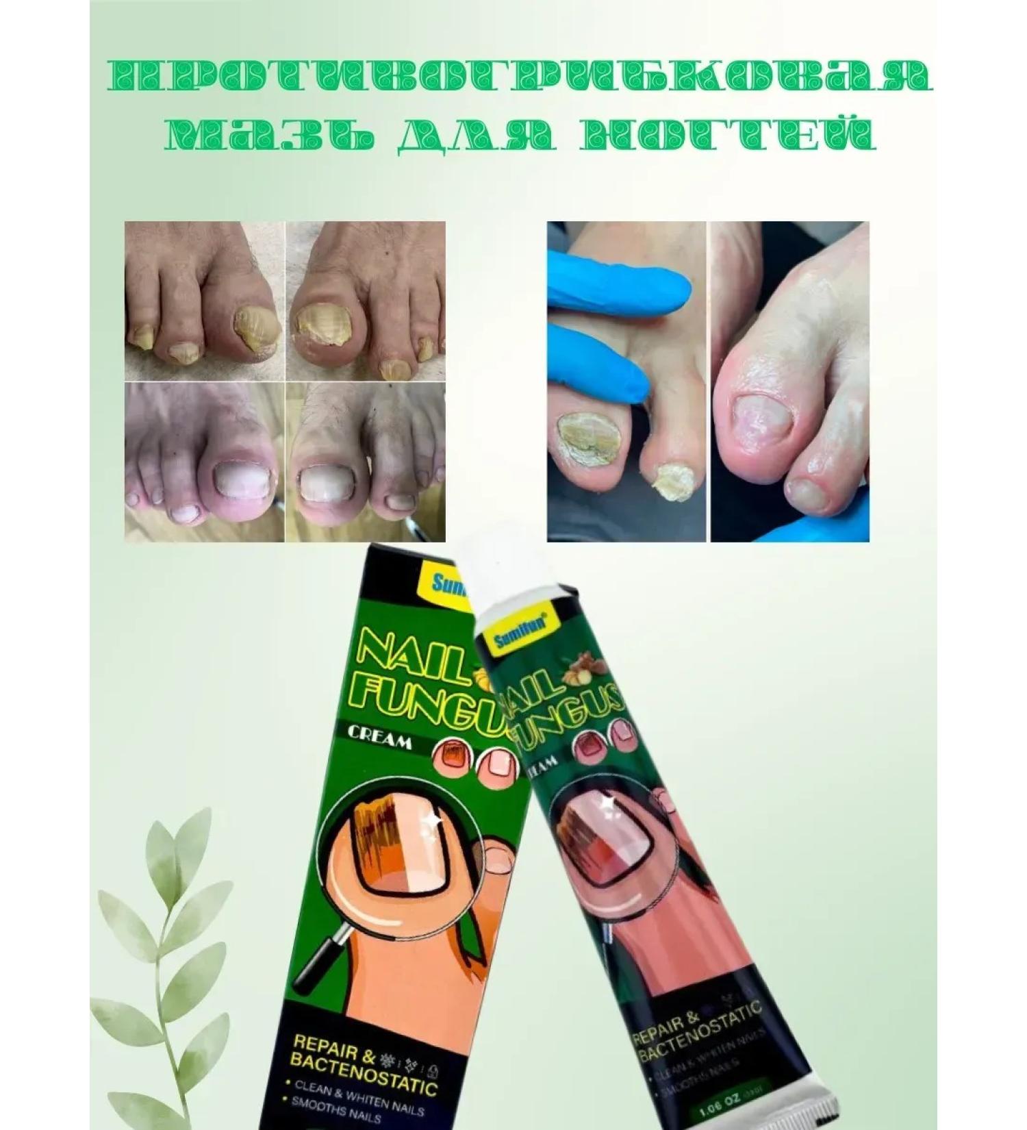 Ointment for the treatment of the fungus on the nail and between the fingers