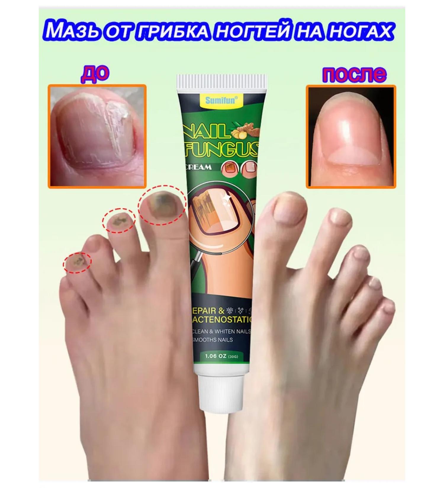 Ointment from nail fungus antifungal 30 ml - Buy Online on GoSupps.com