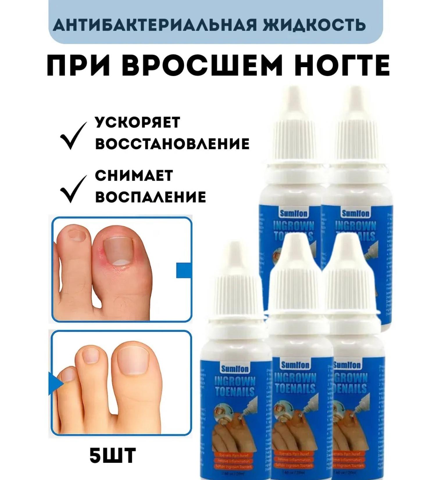 mua Remedy for the restoration of ingrown nails 5 pcs - Buy Online on GoSupps.com