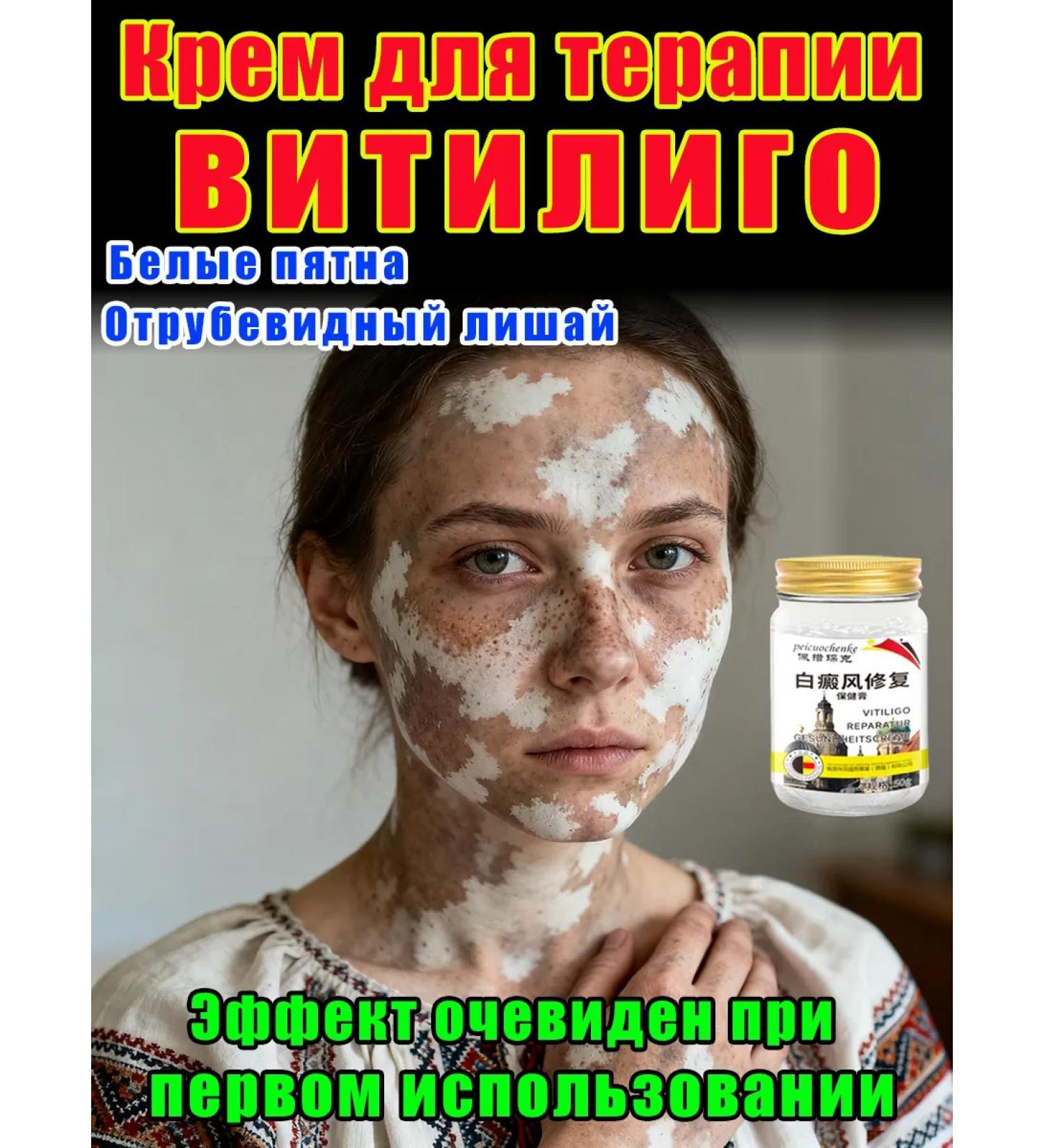 Vitiligo cream treatment efficiently removes white spots - Buy Online on GoSupps.com