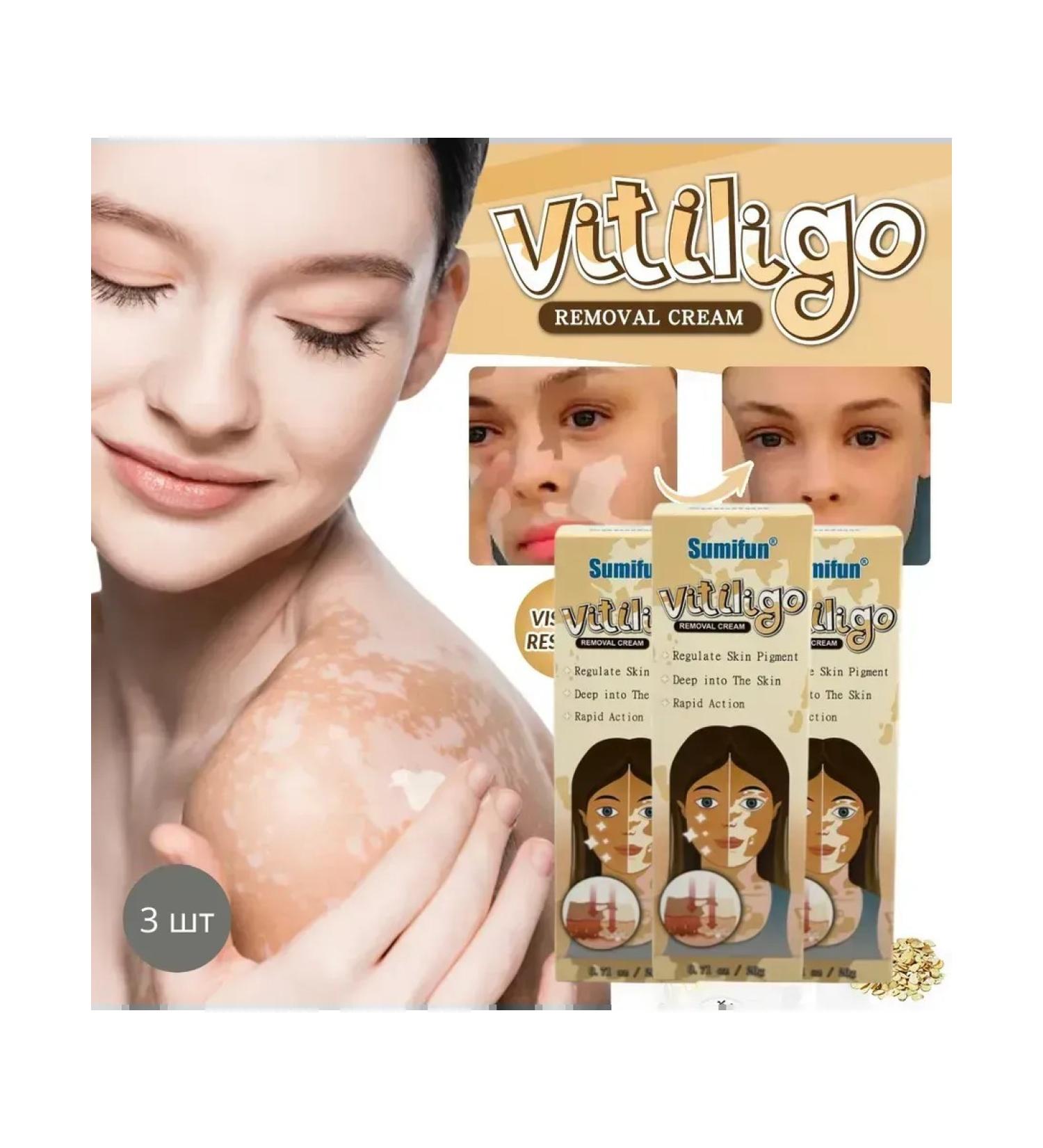 MaxWish 09 Cream for removing freckles and pigment spots of vitiligo 3pcs - Buy Online on GoSupps.com