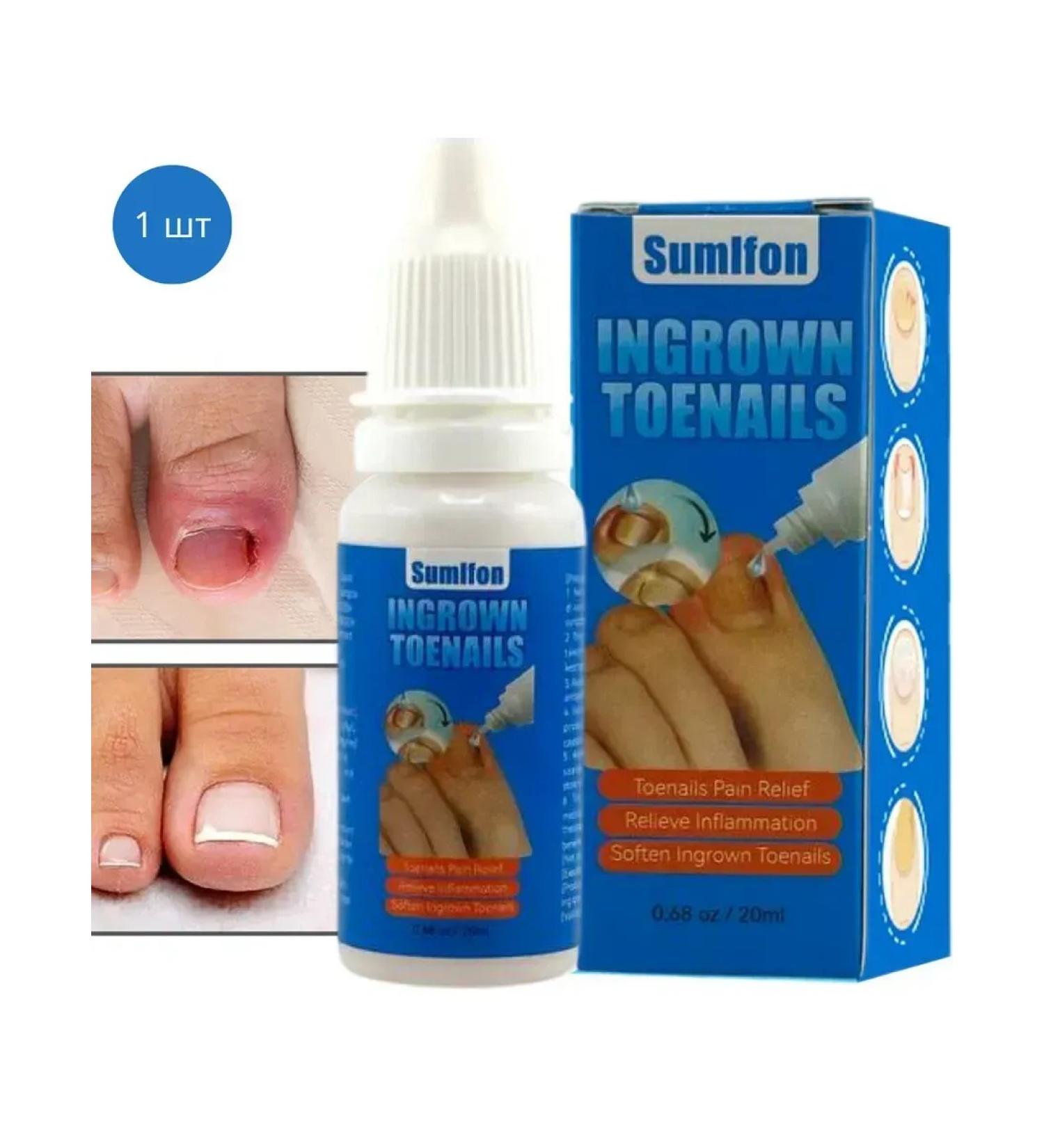 MaxWish 09 Antibacterial fluid for the treatment of ingrown nails 1 pcs - Buy Online on GoSupps.com