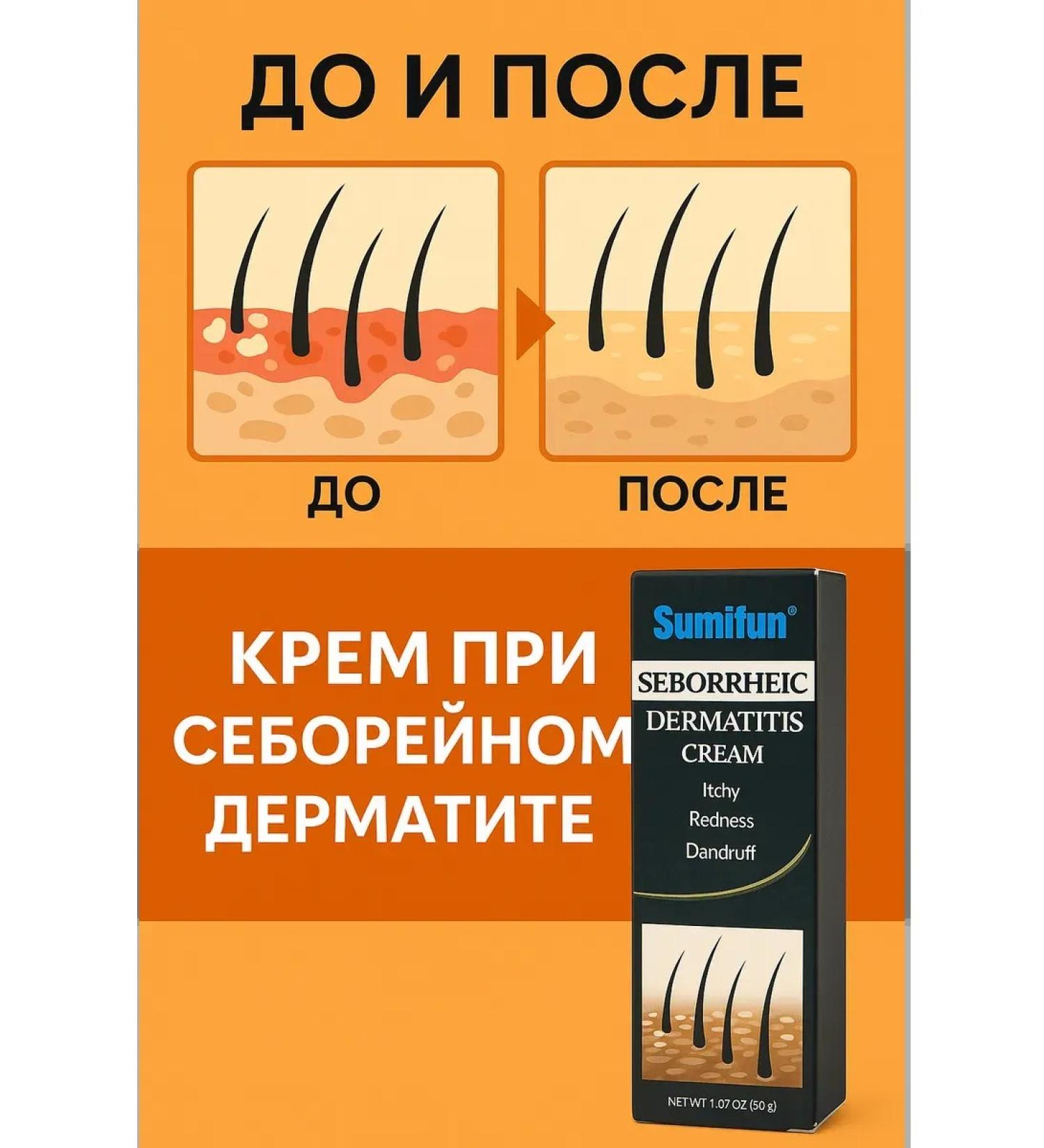 DK MILLION Cream from seborrheic dermatitis