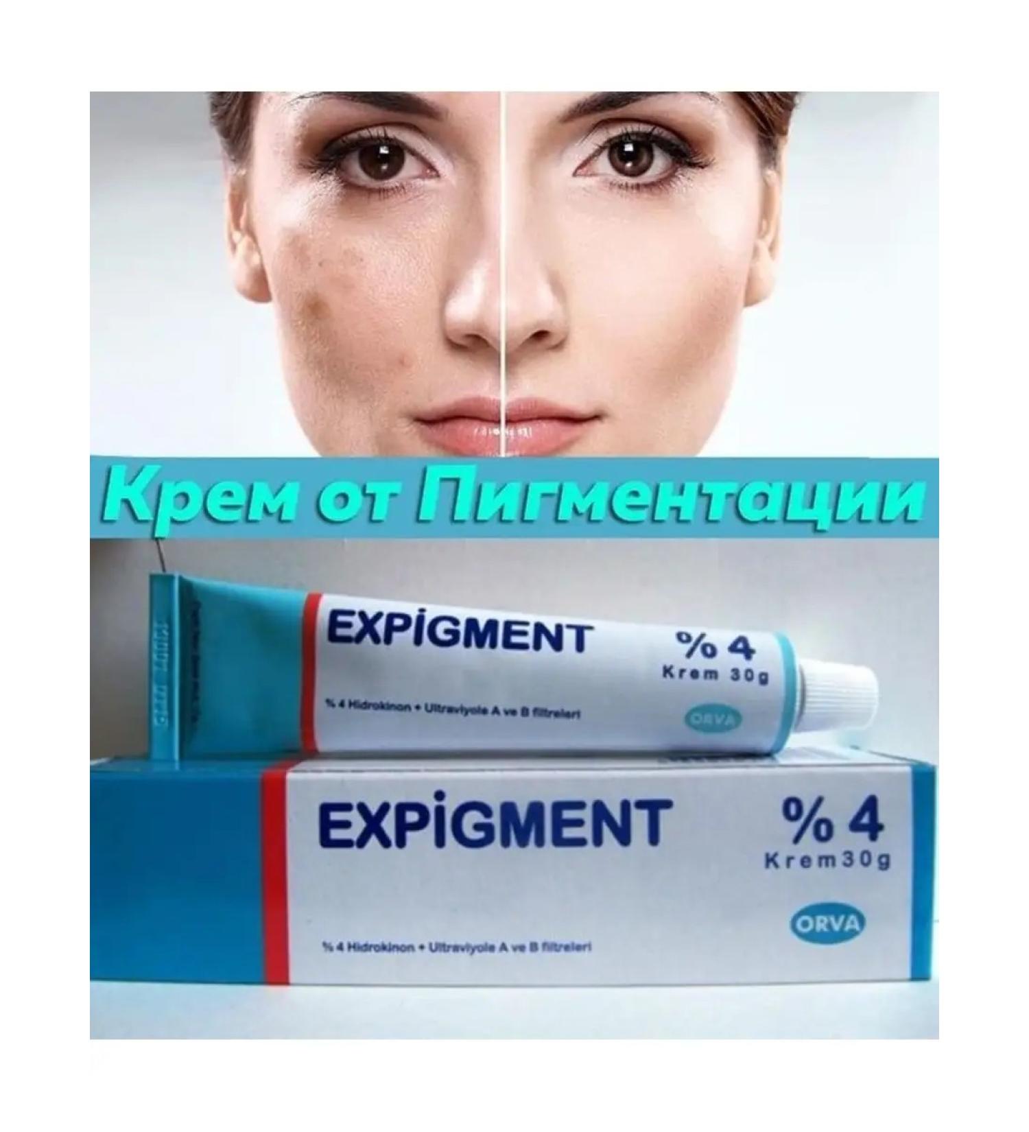 Zhasstyle Expigment 4% Whitening Cream for Age Spots with Hydroquinone/Anti-Pigmentation