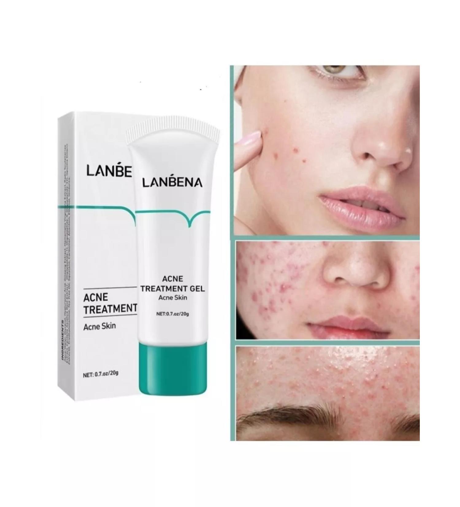 LANBENA from acne acne from rashes 20 g - Buy Online on GoSupps.com