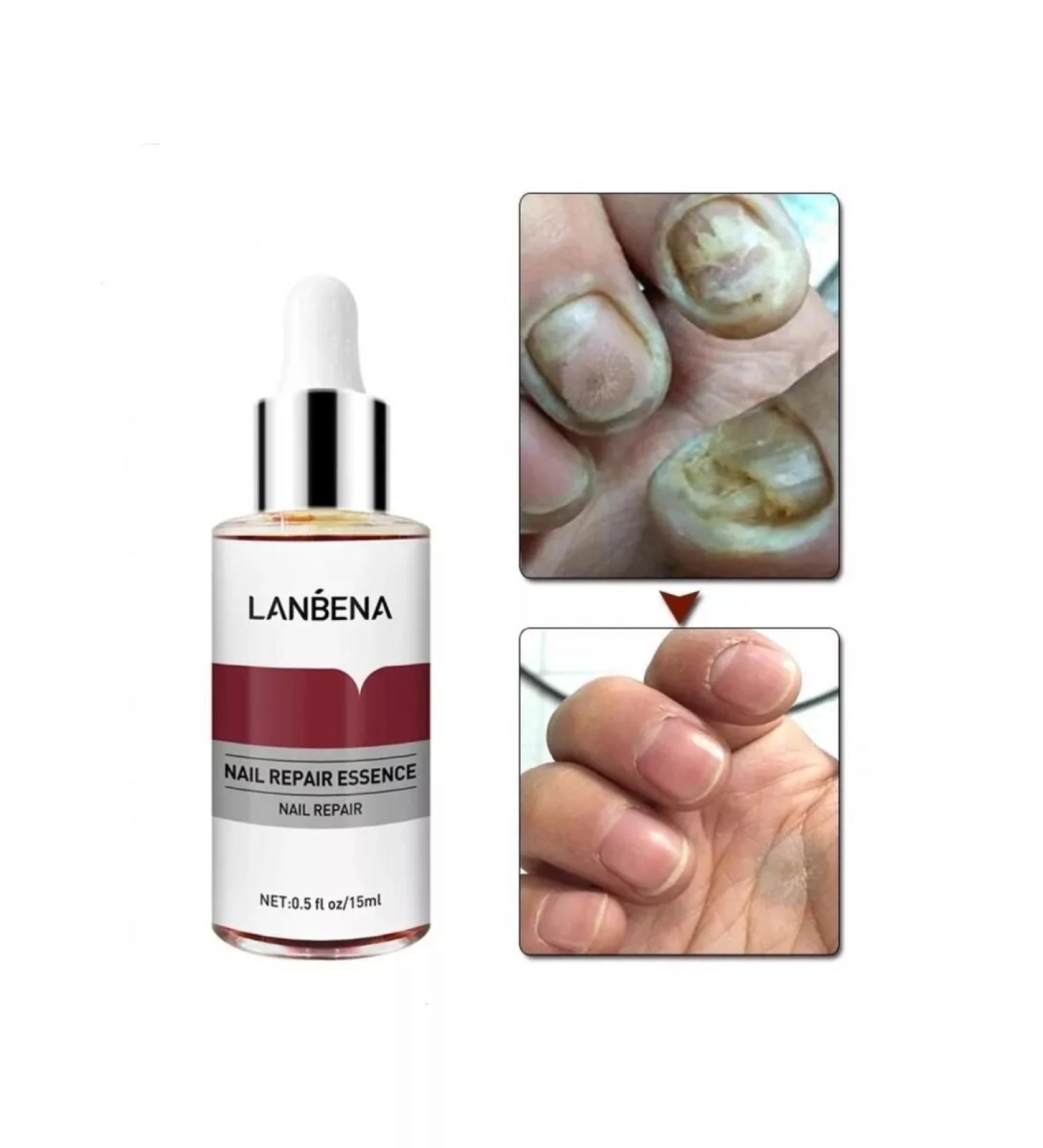LANBENA From nail fungus on the legs 15 ml - Buy Online on GoSupps.com