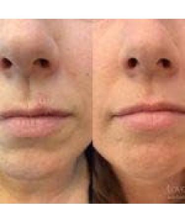 FixMySkin Vanilla Healing Lip Balm - Soothes and Repairs Dry Lips - Buy Online on GoSupps.com