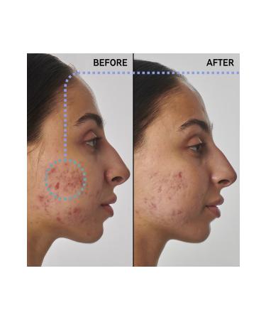 THE INKEY LIST Acne-Acne Scar Repair 1% Retinol - Face Serum 30 Ml Ko ak419 - Buy Online on GoSupps.com
