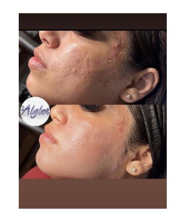 DR.ALGLER Algae Peeling Professional 5 Uses - Buy Online on GoSupps.com