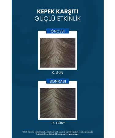 Ducray Kelual DS Anti-Scaling Flaking and Intensive Dandruff Care Shampoo 100ml - Buy Online on GoSupps.com