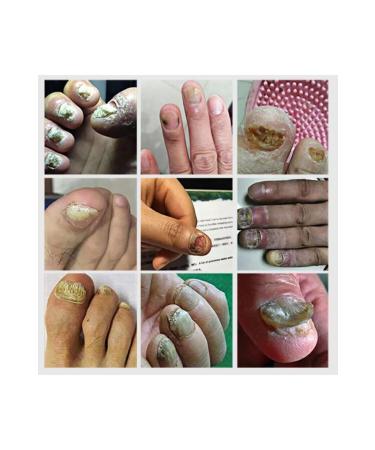 LANBENA Nail Repair Gel Nail Repair Care Gel Nail Care Gel - Buy Online on GoSupps.com