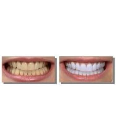 8 Large 10ml Professional 36% Teeth Whitening Gels - Optimized Formula By White Smile- 80ml by White Smile Global - Buy Online on GoSupps.com