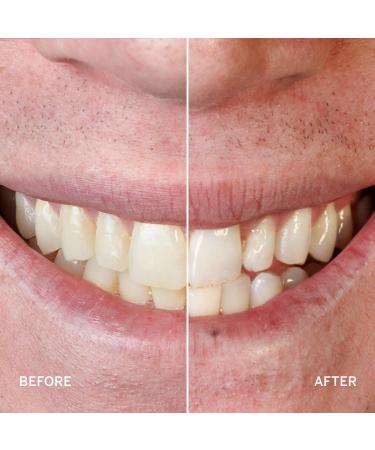 Supersmile Professional Whitening System - Transform Your Style with the Best Innovation Today! - Buy Online on GoSupps.com