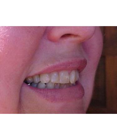 Instant White Smile Wholesale DIY Thermo-molding Boil and Bite Mouth Trays - Pack of 10 - Buy Online on GoSupps.com