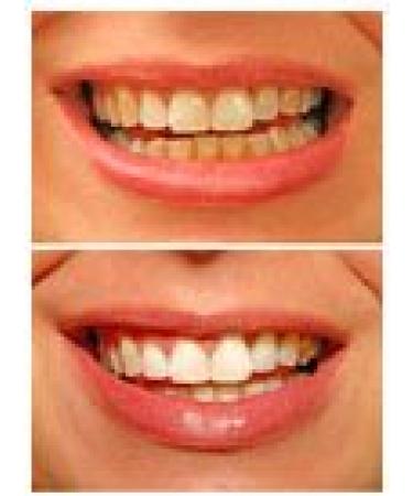 Professional Strength 36% Carbamide Peroxide Teeth Whitening Gel - 30cc Syringes (No Trays) | Includes Shade Card - Instant White Smile - Buy Online on GoSupps.com