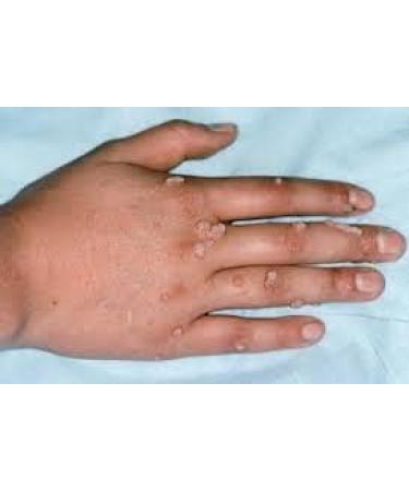 Naturasil Wart Remover - Fast-Acting All-Natural Liquid | Painless & Acid-Free | Made in USA - Buy Online on GoSupps.com