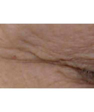 Eyes Lifting Cocktail Serum - Sterile Microneedling & Mesotherapy Treatment - 5ml Professional Ampoule - Buy Online on GoSupps.com