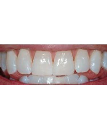 Professional Strength 36% Carbamide Peroxide Teeth Whitening Gel - 30cc Syringes (No Trays) | Includes Shade Card - Instant White Smile - Buy Online on GoSupps.com