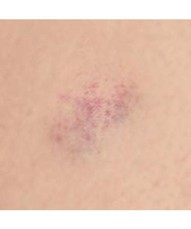 Doctor Petit Cream Bundle for Bruises, Eye bags, Sunburn, Dark Spots - 2 Pack 1 Oz Pocket Size - Buy Online on GoSupps.com