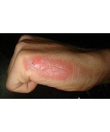 Natural Cream For Skin Healing Burns Sunstrokes Insect Bites Eczema - Buy Online on GoSupps.com