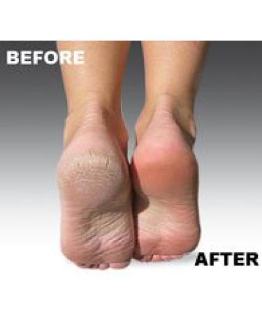 Emjoi Micro-Pedi FLEX Technology Refill Rollers - Extra Coarse - Buy Online on GoSupps.com