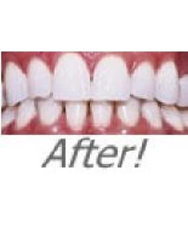 Professional Strength 36% Carbamide Peroxide Teeth Whitening Gel - 30cc Syringes (No Trays) | Includes Shade Card - Instant White Smile - Buy Online on GoSupps.com