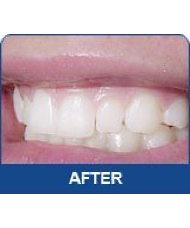 10 3ml Syringes Teeth Whitening Kit with 44% Carbamide Gel by White Teeth Global - Professional Dental Bleaching Treatment - Buy Online on GoSupps.com